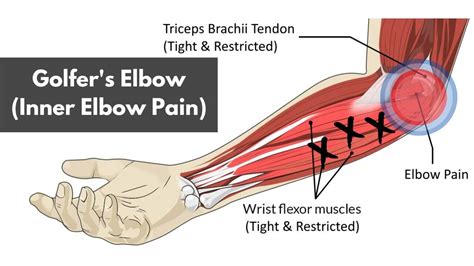 golfer's elbow muscles involved.